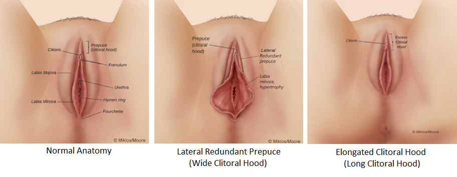 shrouded clitoris Surgery