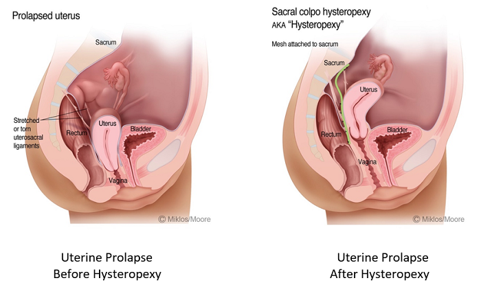 Uterus preservation in pelvic organ prolapse surgery