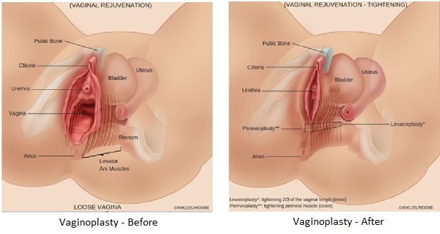 VAGINOPLASTY - Surgical Tightening - Vaginoplasty.com - All About ...