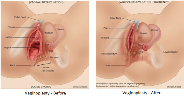 Vaginoplasty Before and After Illustration