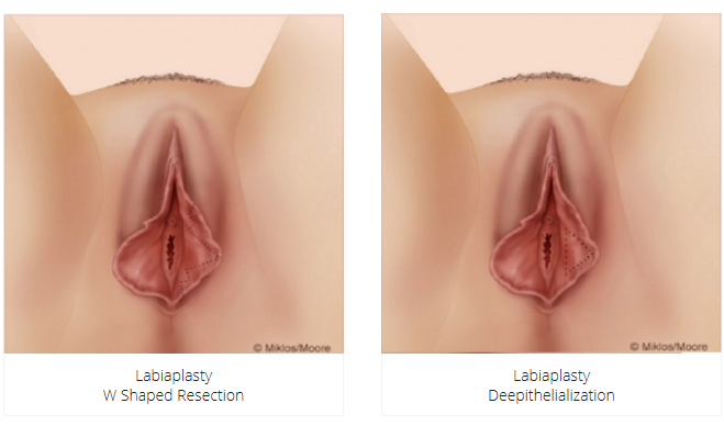LABIAPLASTY - Labia Minora Reduction - Vaginoplasty.com - All About Vaginal...